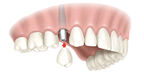 Single Dental Implants Sanford