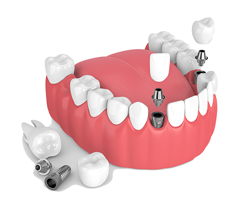 Multiple Teeth Dental Implants in Sanford